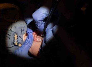 Prevent Overuse of Tongue-Tie Surgeries in Children: Pediatricians’ Warning news-04082024-054321