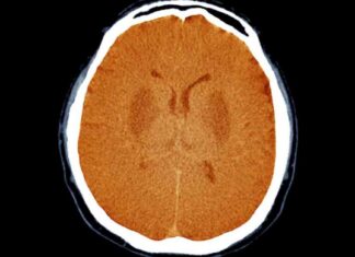 Awareness in Unresponsive Brain-Damaged Patients: What to Know news-15082024-074806