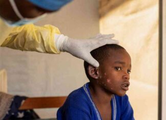 Understanding the Global Emergency of Mpox and Future Implications news-15082024-202902