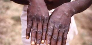 Understanding the Mpox Outbreak: Public Health Emergency and Increased Virus Risk in Africa news-16082024-204034