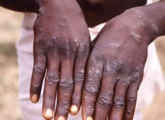 Understanding the Mpox Outbreak: Public Health Emergency and Increased Virus Risk in Africa news-16082024-204034