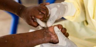 Understanding the Differences in the Current and 2022 MPOX Strain: Key Information news-17082024-144046
