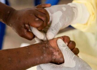 Understanding the Differences in the Current and 2022 MPOX Strain: Key Information news-17082024-144046