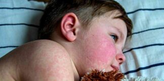 Understanding Parvovirus: CDC Warning & Key Information news-20082024-133527