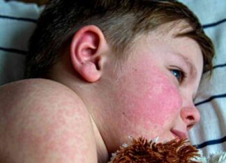 Understanding Parvovirus: CDC Warning & Key Information news-20082024-133527