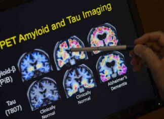 Alzheimer’s Drug Linked to Increased Brain Bleed Risk in Down Syndrome Patients news-22082024-072017