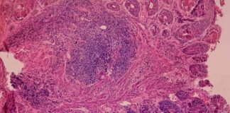 Checkpoint Inhibitor from Incyte Delays Disease Progression in Anal Cancer Study news-14092024-185729