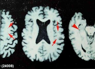 Study suggests one-third of ex-NFL players believe they have CTE news-26092024-002434