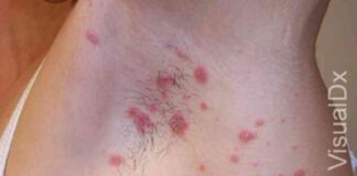 Understanding Guttate Psoriasis in Adults: Causes, Symptoms, Treatment news-14112024-221721