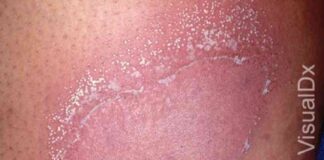 Understanding Generalized Pustular Psoriasis in Adults: Symptoms, Treatments, and Images news-15112024-041829