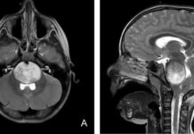 CAR-T Therapy Shows Promise in Treating Aggressive Brain Tumors in Young Patients news-15112024-162349