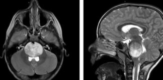 CAR-T Therapy Shows Promise in Treating Aggressive Brain Tumors in Young Patients news-15112024-162349