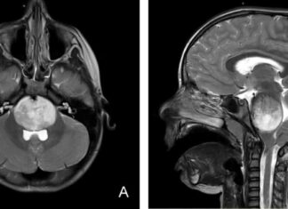 CAR-T Therapy Shows Promise in Treating Aggressive Brain Tumors in Young Patients news-15112024-162349