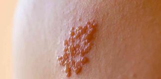 Prevent Shingles Effectively with Vaccination: Tips from NIH MedlinePlus prevent-shingles-effectively-with-vaccination-tips-from-nh-medlineplus