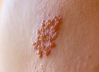 Prevent Shingles Effectively with Vaccination: Tips from NIH MedlinePlus prevent-shingles-effectively-with-vaccination-tips-from-nh-medlineplus