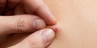 Understanding How Warts Spread and How to Protect Yourself