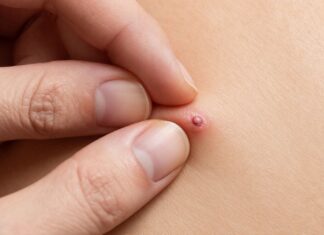 Understanding How Warts Spread and How to Protect Yourself