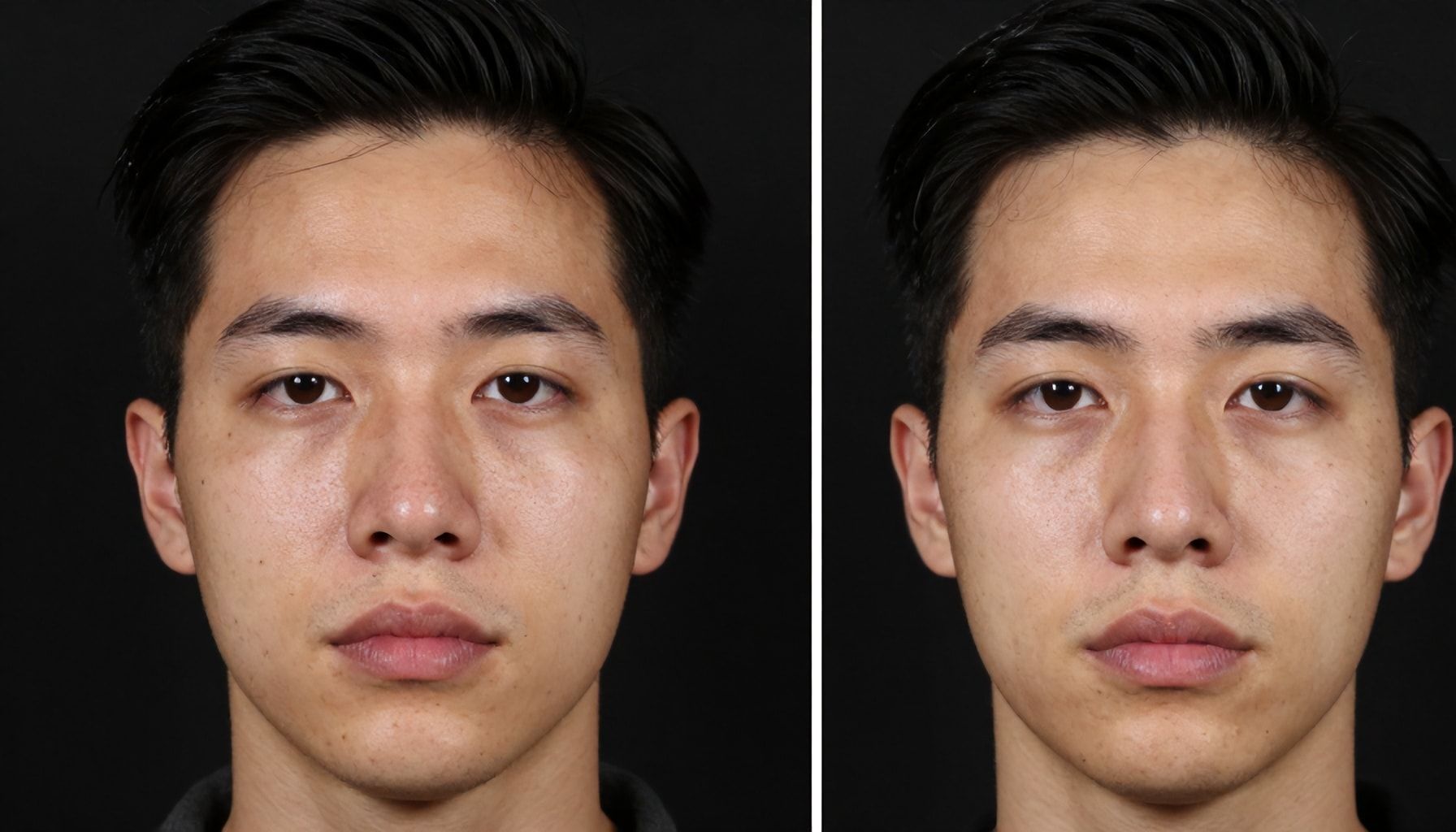 Before & After Masseter Botox: Real Results You Can Expect*