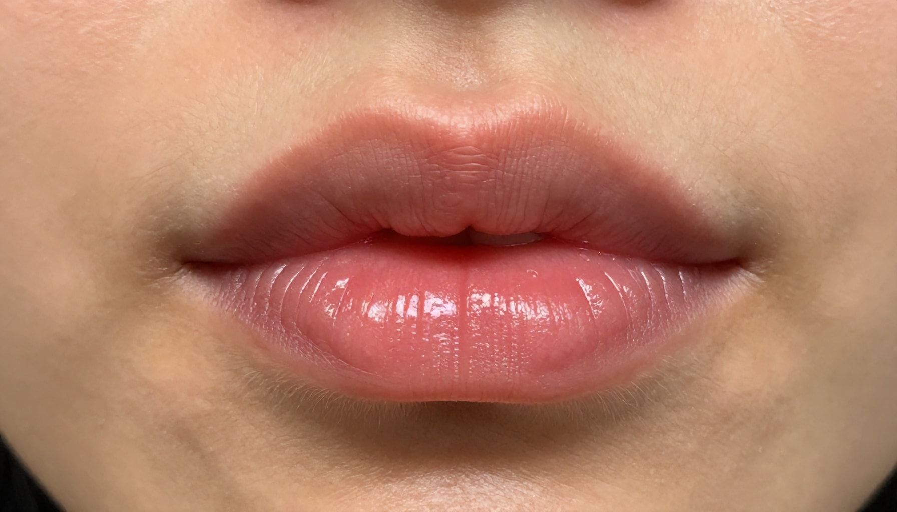 Before and After: See the Dramatic Transformation of a Lip Flip*