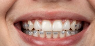 Straighten Your Smile with Discreet Back Braces