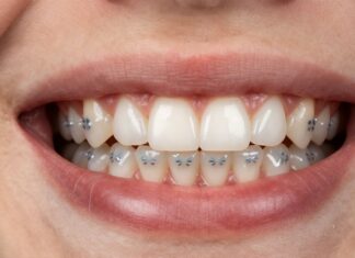 Straighten Your Smile with Discreet Back Braces