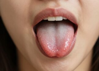 Understanding and Treating Bumps on Your Tongue