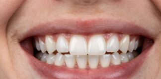 Straighten Your Smile Discreetly with Ceramic Braces