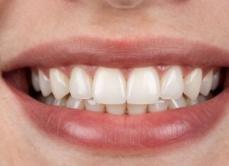 Restore Your Smile with Durable Dental Veneers for Missing Teeth