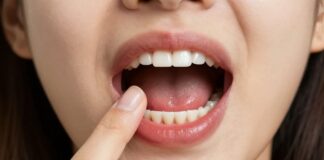 Relieve Dry Socket Pain After Wisdom Teeth Removal