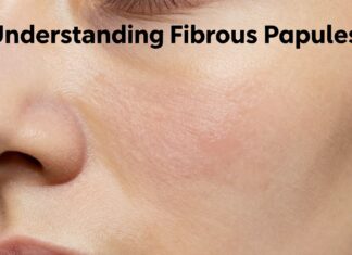 Understanding Fibrous Papules: Causes, Treatment, and Skin Health Benefits