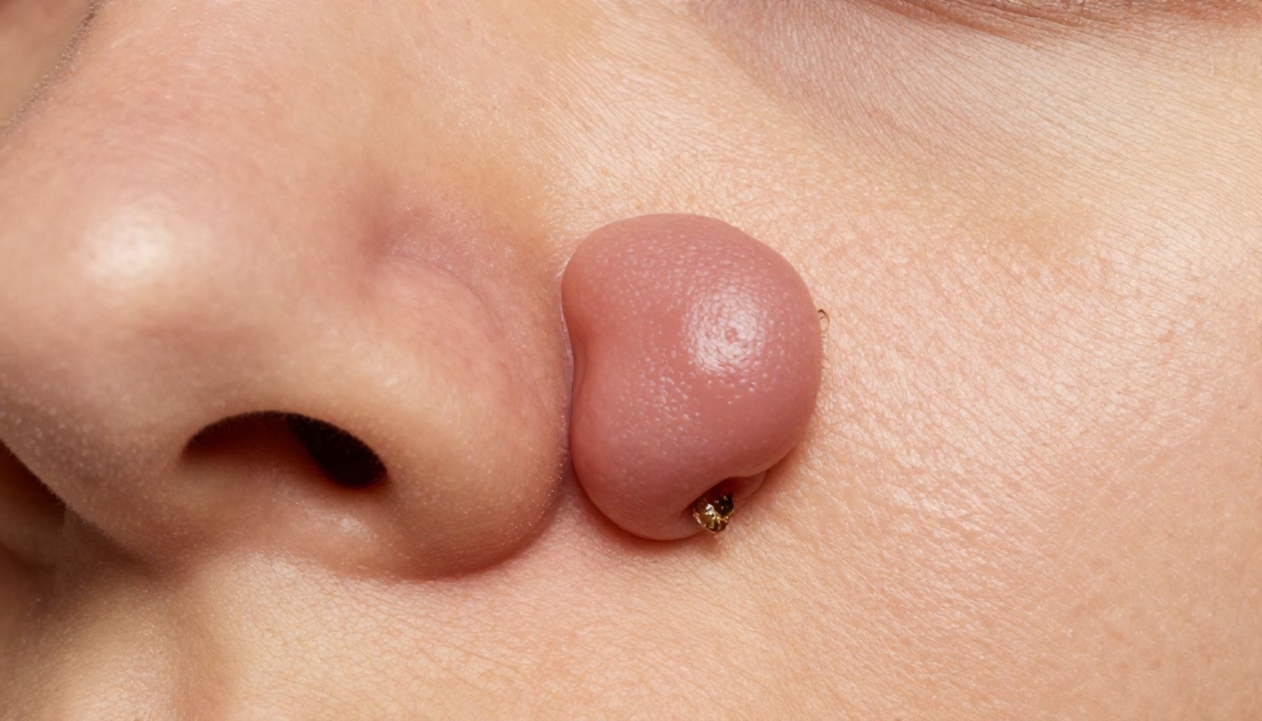 How Fibrous Papules Form and Why They Persist on Your Skin*