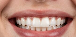 Discover the Cost of Veneers: A Clear Guide to Your Perfect Smile