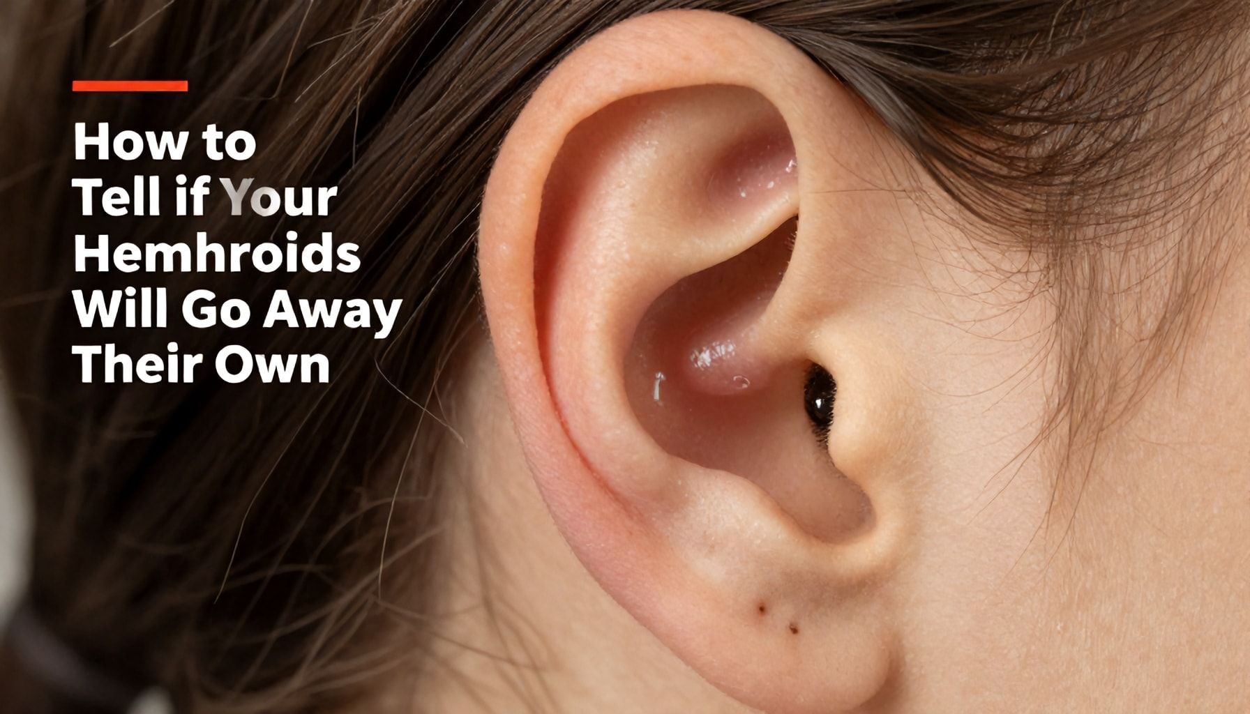 How to Tell If Your Hemorrhoids Will Go Away on Their Own*