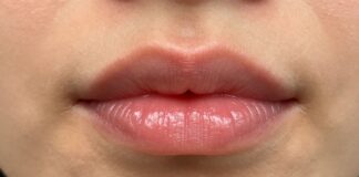 See the Stunning Results of a Lip Flip Before and After