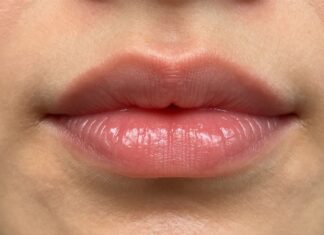 See the Stunning Results of a Lip Flip Before and After