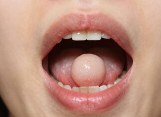 Understanding and Treating Lumps in Your Mouth’s Roof
