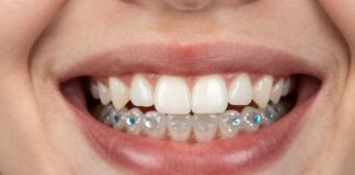 Keep Your Straight Smile for Life with a Permanent Retainer