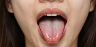 Understanding and Treating Pimples at the Back of Your Tongue