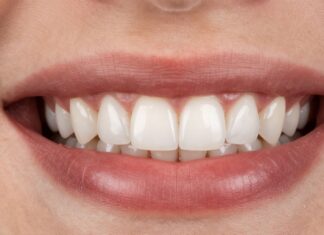 Transform Your Smile with Durable, Natural-Looking Porcelain Veneers