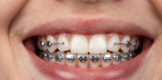 Straighten Your Smile Faster with Power Chain Braces