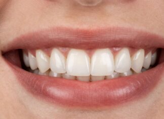 Transform Your Smile with Durable, Natural-Looking Veneers