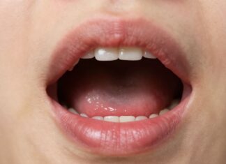 Recognize a Dry Socket: Key Signs to Watch For