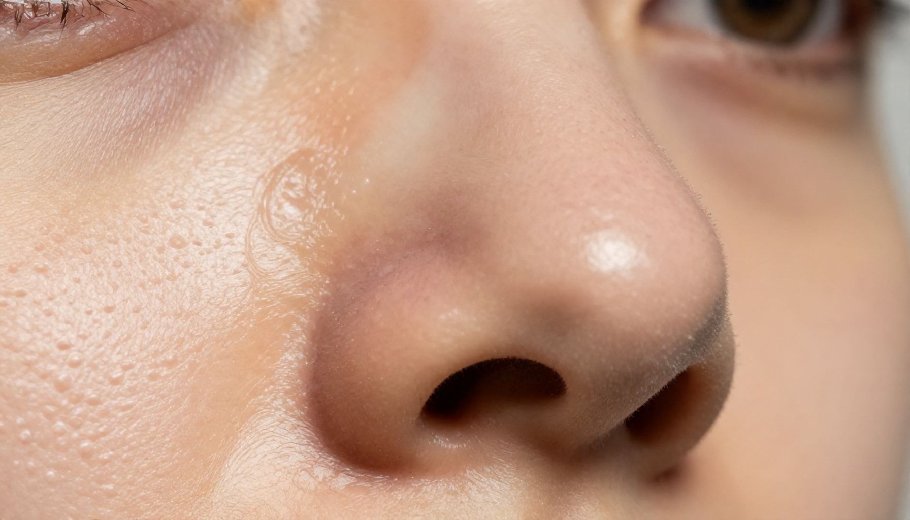 Why Fibrous Papules Appear on Your Nose (And How to Prevent Them)*