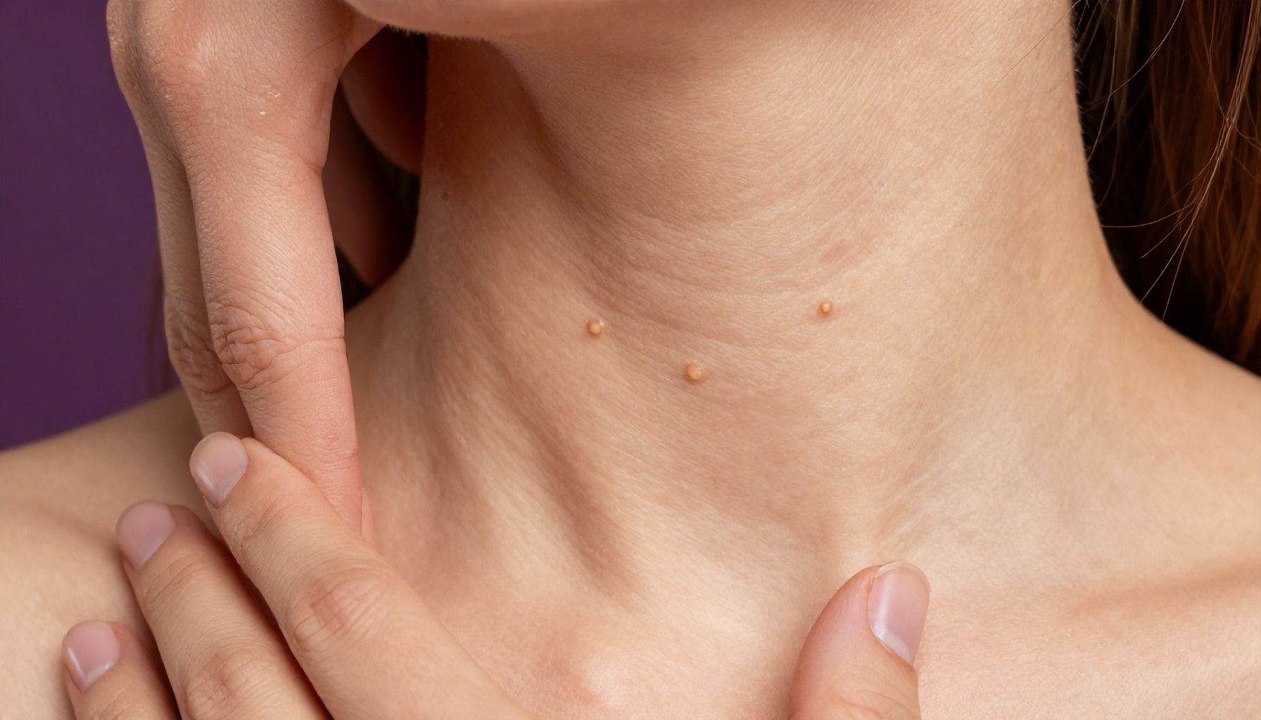 Why Warts Are Contagious—and How to Stop the Spread*